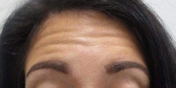 Botox Before & After