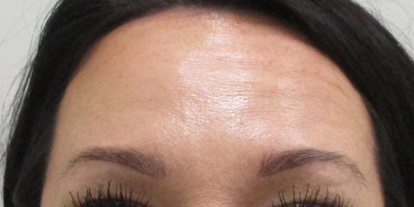 Botox Before & After