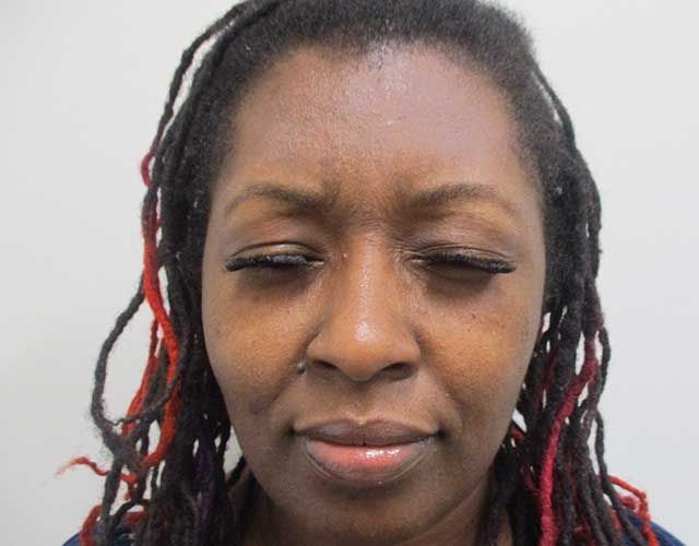 Botox Before & After