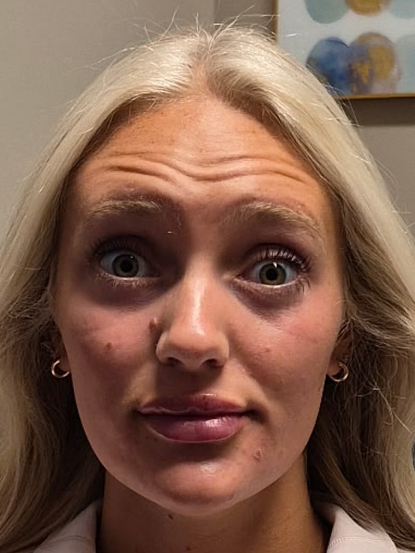 Botox Before & After