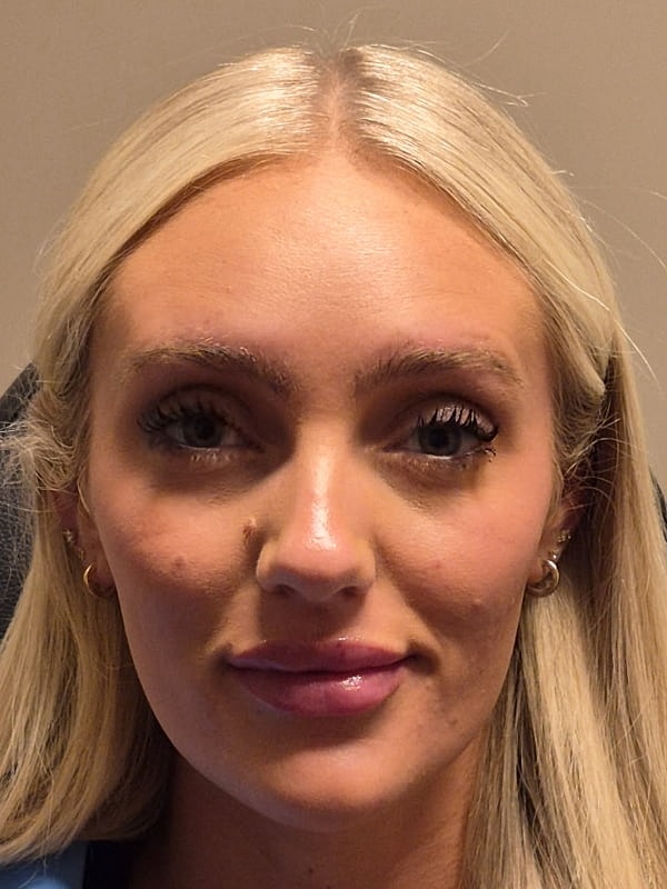 Botox Before & After