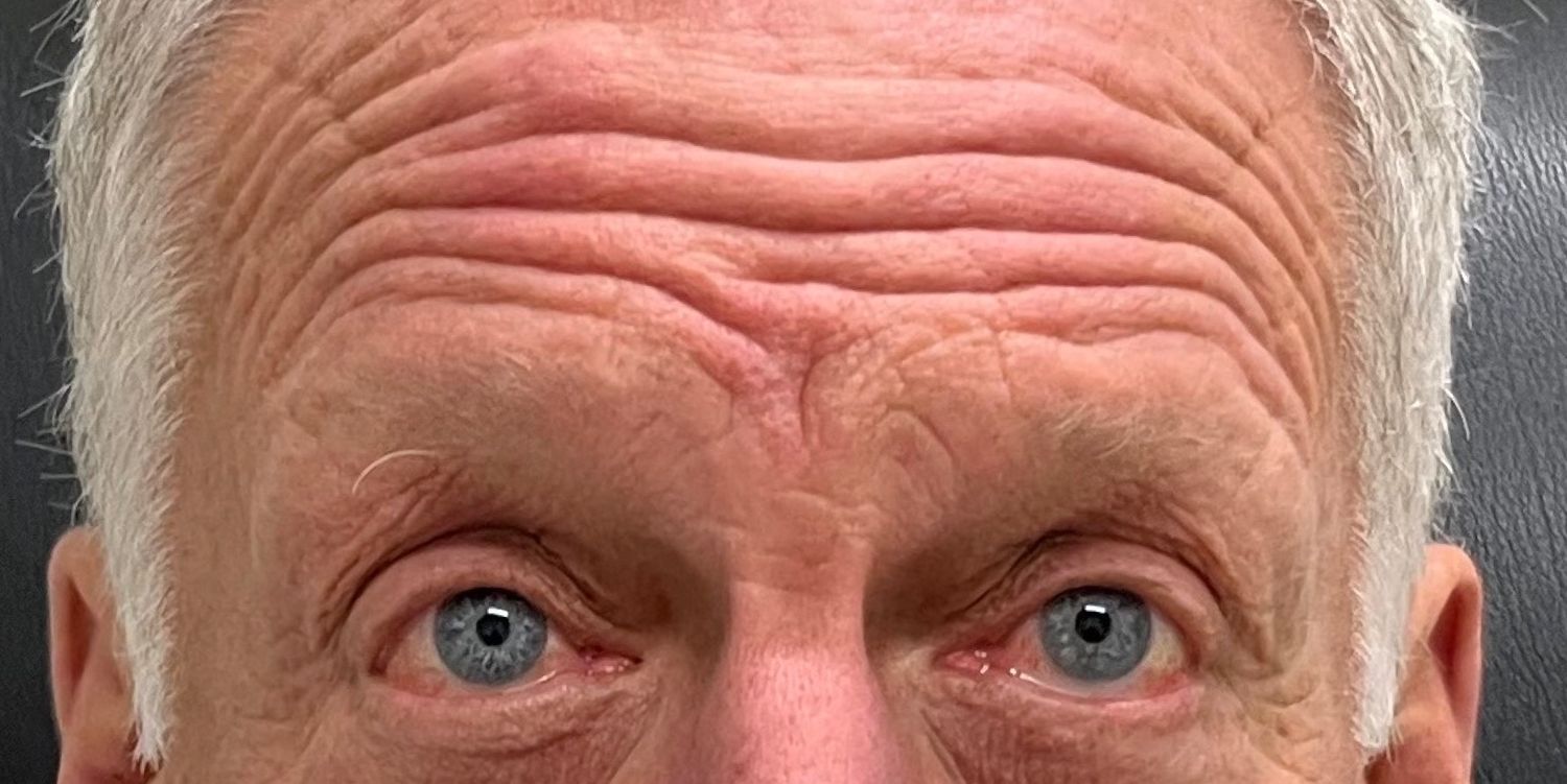 Botox Before & After