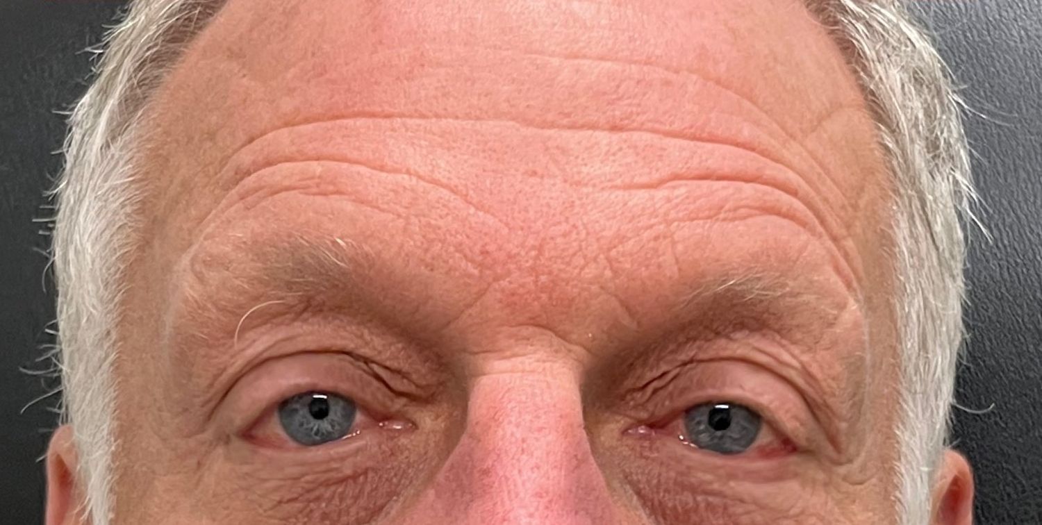 Botox Before & After