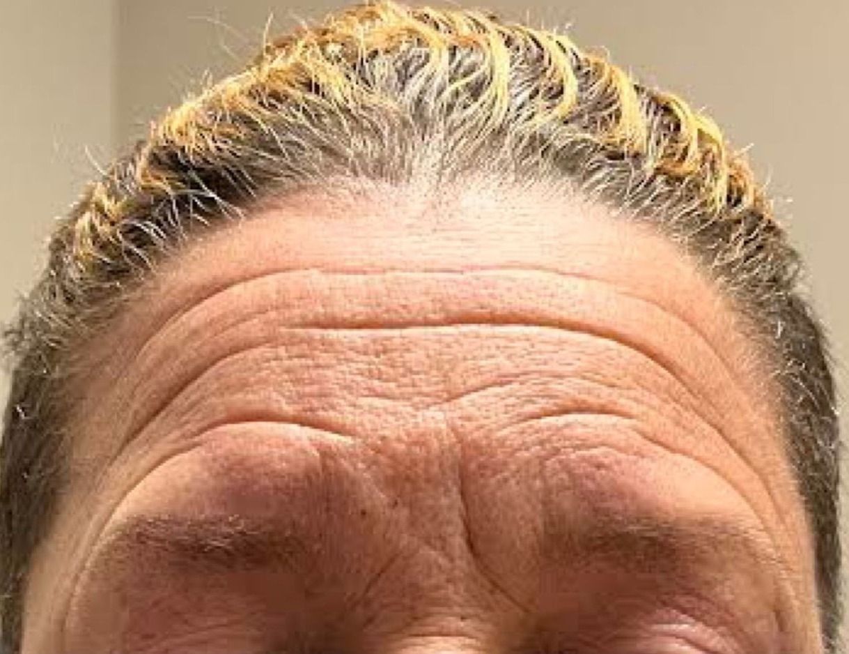 Botox Before & After