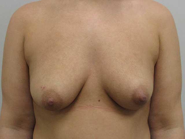 Breast Augmentation Before & After