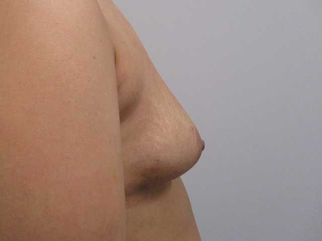Breast Augmentation Before & After