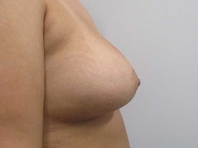Breast Augmentation Before & After