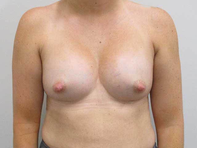 Breast Augmentation Before & After