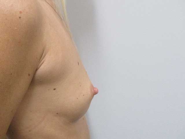 Breast Augmentation Before & After