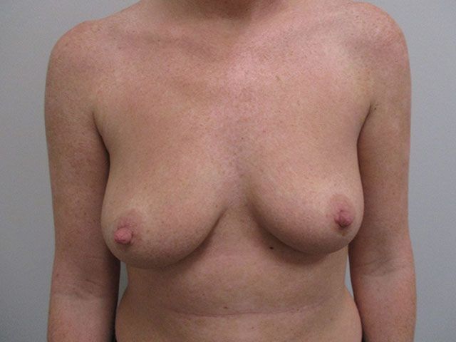 Breast Augmentation Before & After