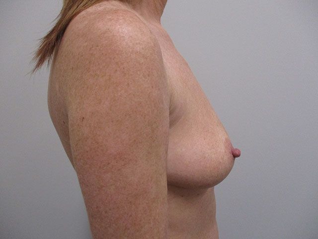 Breast Augmentation Before & After