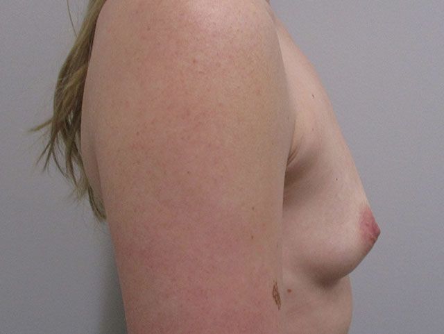 Breast Augmentation Before & After