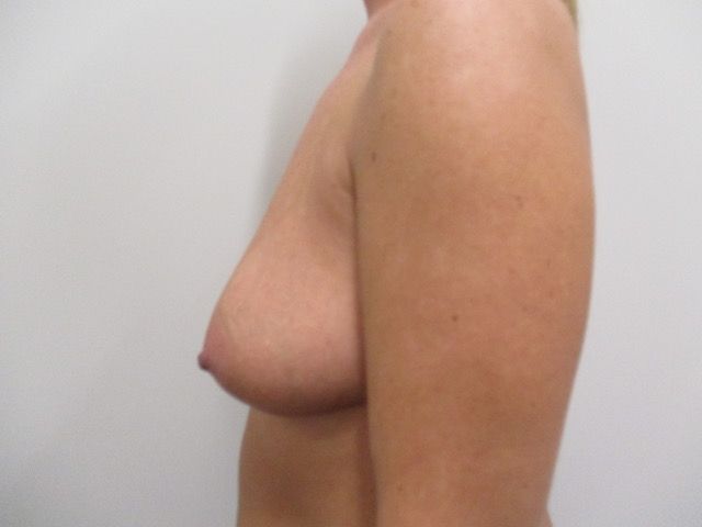 Breast Augmentation Before & After