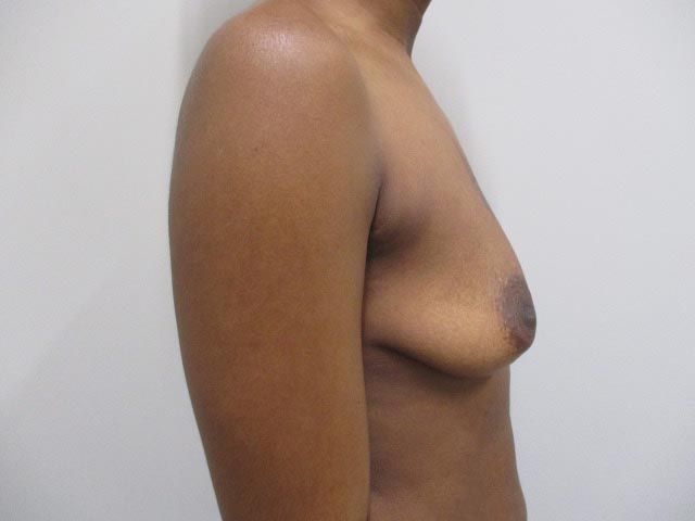 Breast Augmentation Before & After