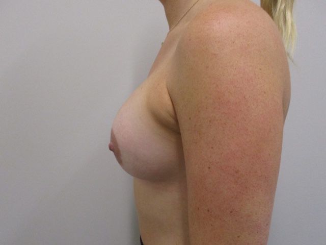 Breast Augmentation Before & After