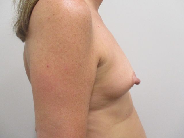 Breast Augmentation Before & After