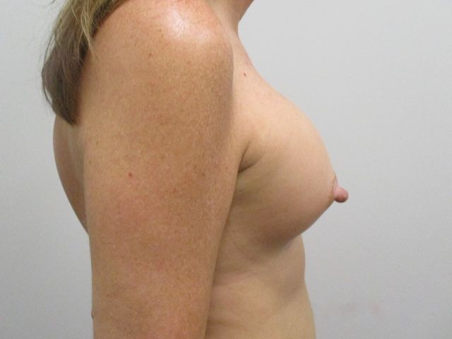 Breast Augmentation Before & After