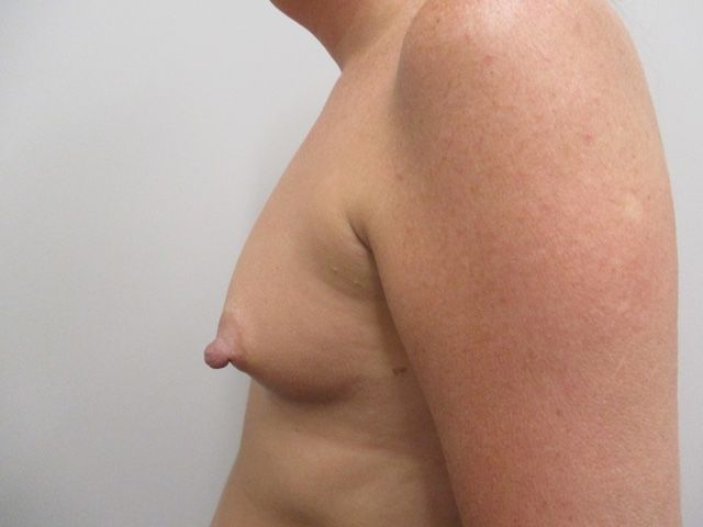 Breast Augmentation Before & After