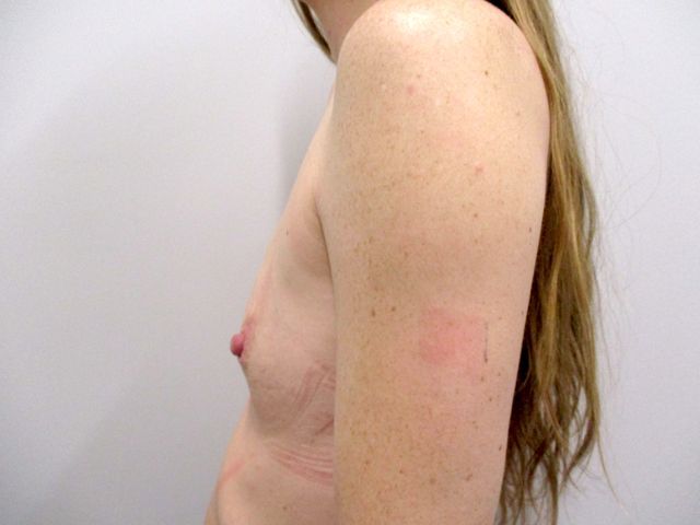 Breast Augmentation Before & After