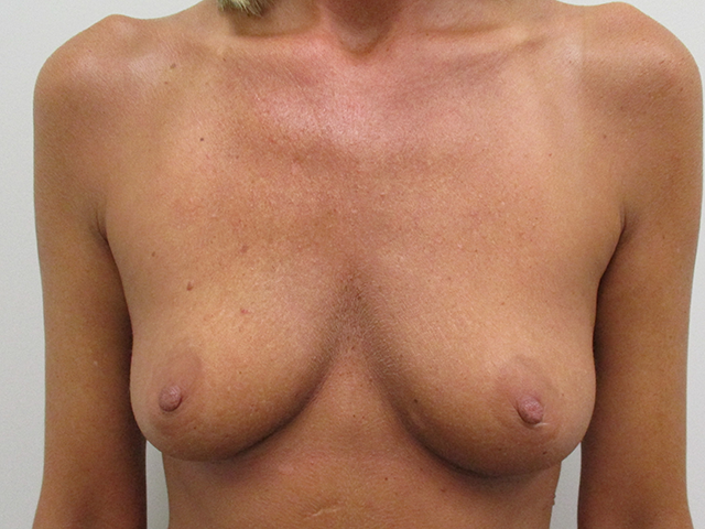 Breast Augmentation Before & After