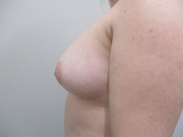 Breast Augmentation Before & After