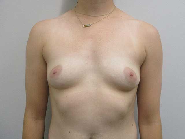 Breast Augmentation Before & After
