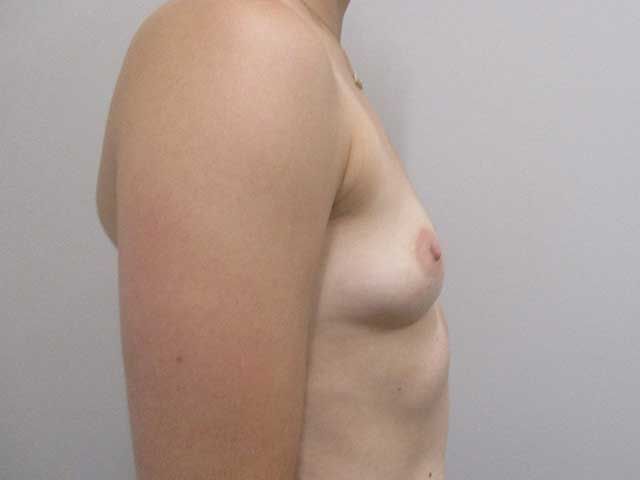 Breast Augmentation Before & After