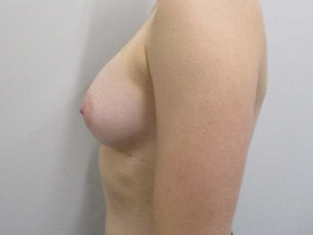 Breast Augmentation Before & After
