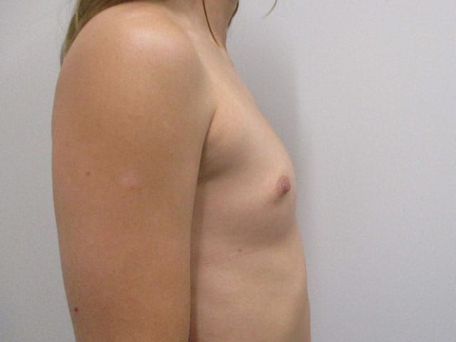 Breast Augmentation Before & After