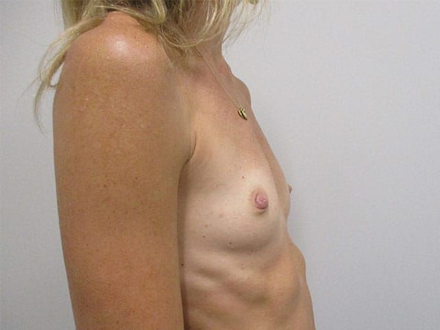 Breast Augmentation Before & After