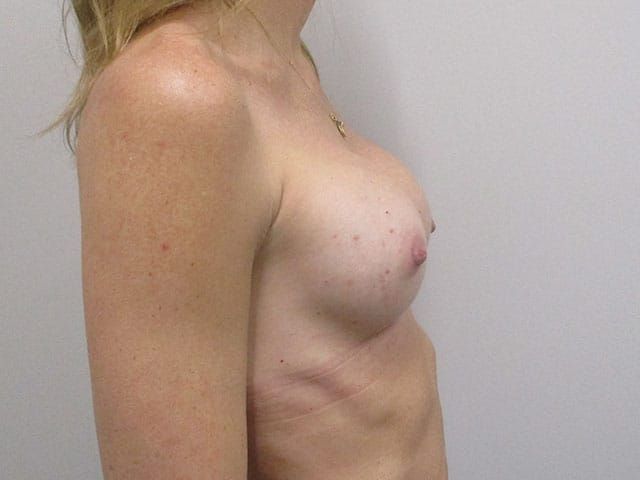 Breast Augmentation Before & After