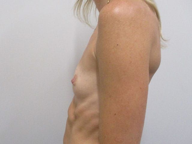 Breast Augmentation Before & After