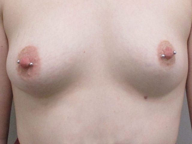 Breast Augmentation Before & After