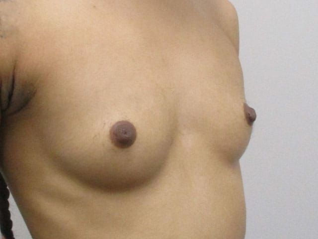 Breast Augmentation Before & After