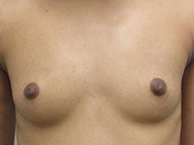 Breast Augmentation Before & After