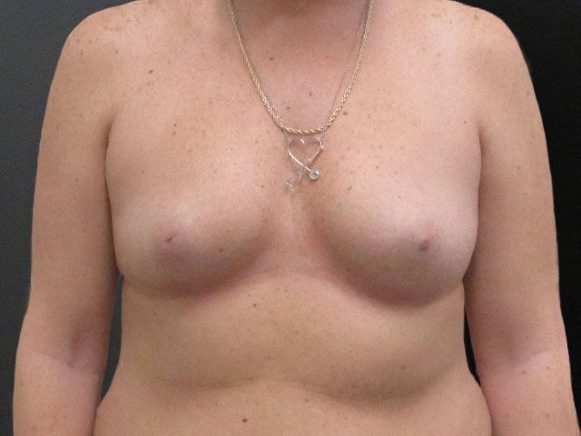 Breast Augmentation Before & After