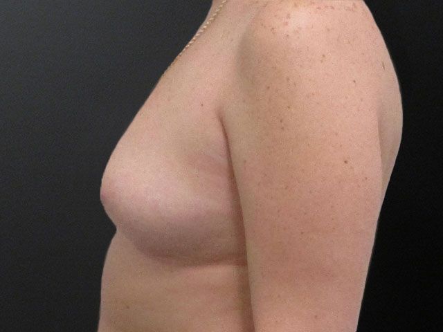 Breast Augmentation Before & After