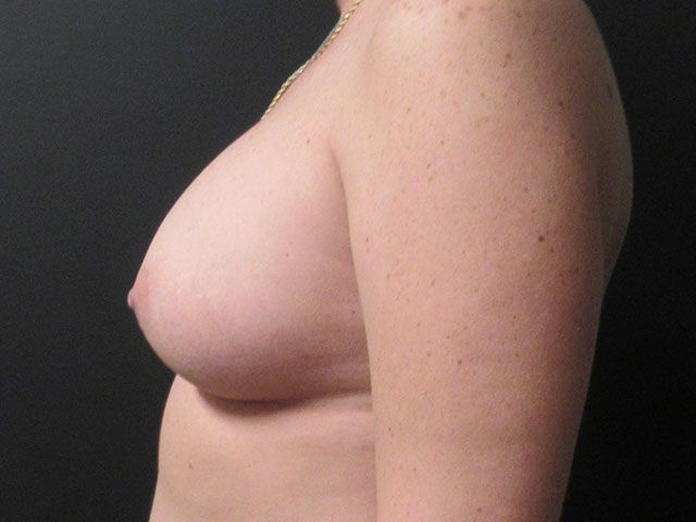 Breast Augmentation Before & After