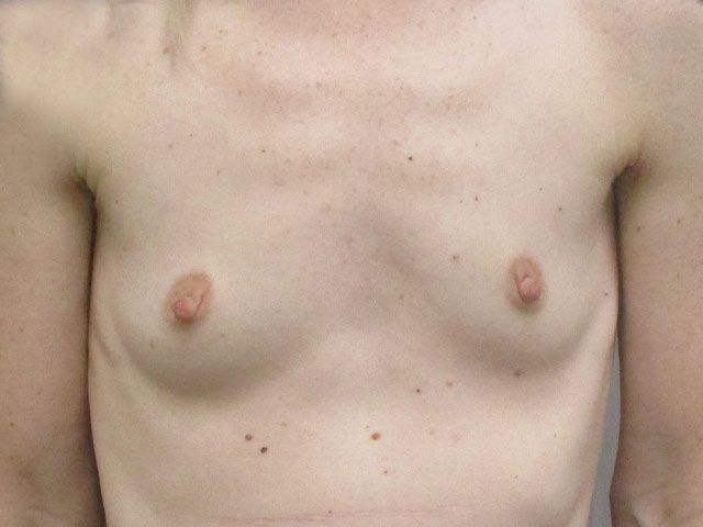 Breast Augmentation Before & After