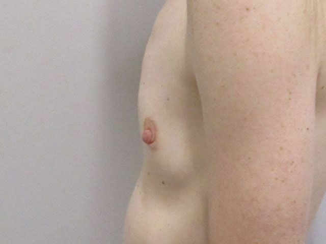 Breast Augmentation Before & After