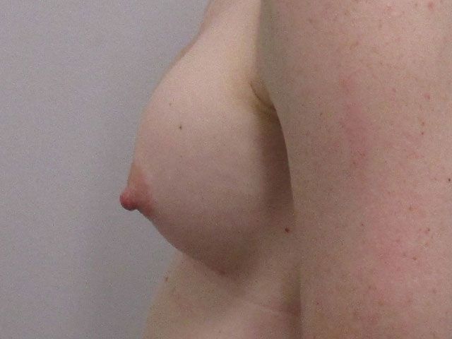 Breast Augmentation Before & After