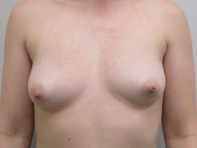 Breast Augmentation Before & After