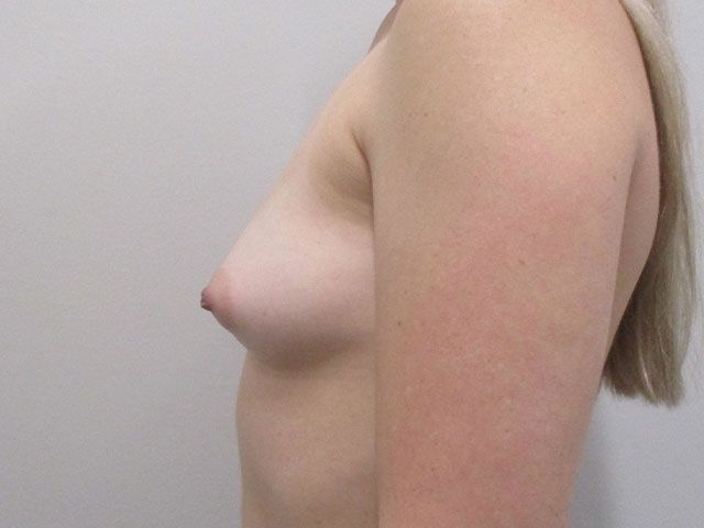 Breast Augmentation Before & After