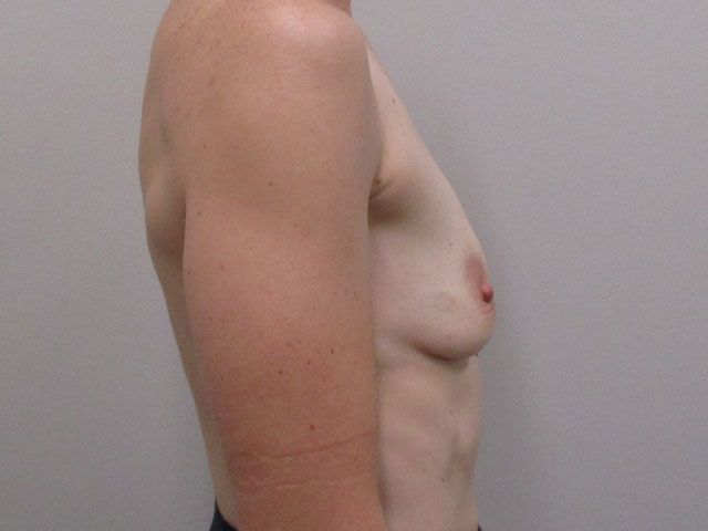 Breast Augmentation Before & After