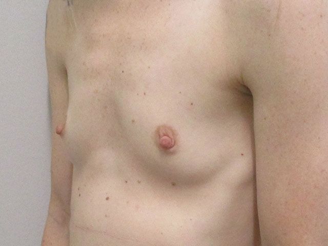 Breast Augmentation Before & After