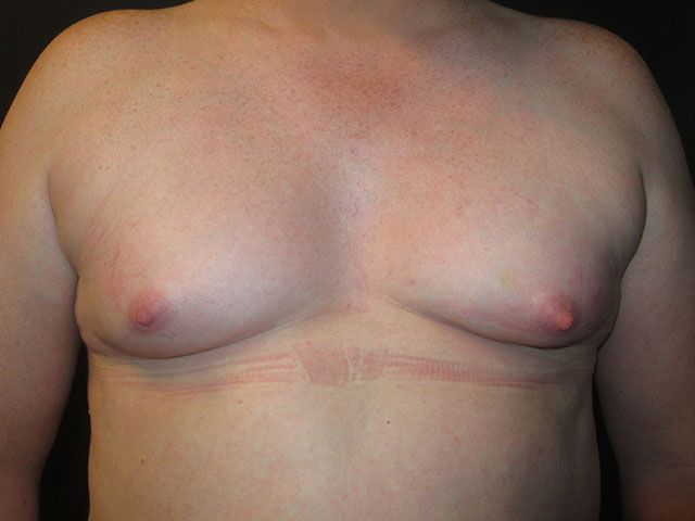 Breast Augmentation Before & After