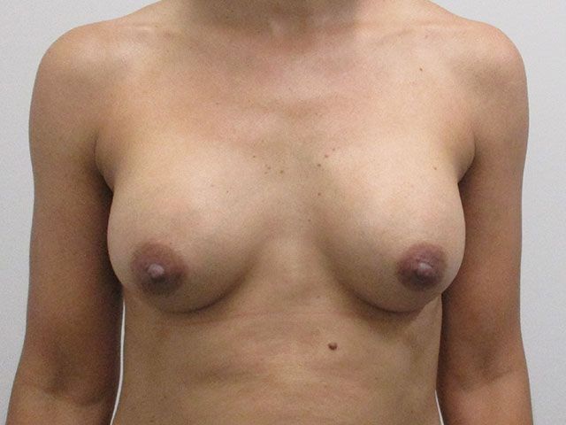Breast Augmentation Before & After
