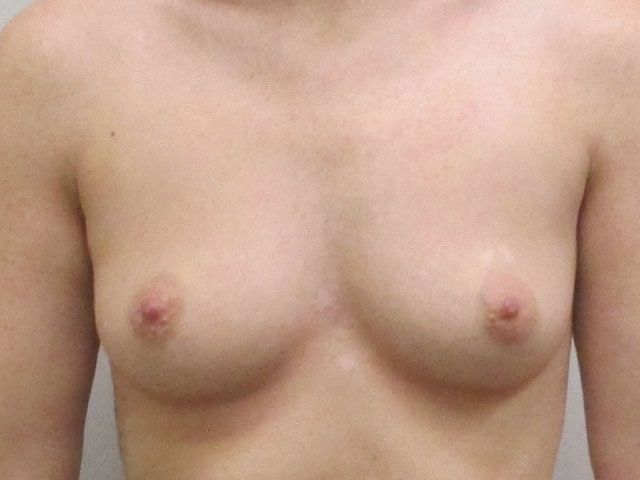 Breast Augmentation Before & After