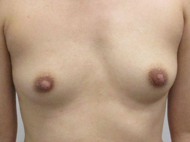 Breast Augmentation Before & After