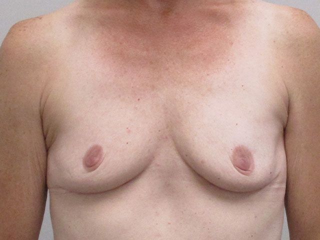 Breast Augmentation Before & After